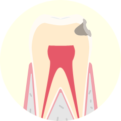 基本治療(軽度の歯周病の場合)