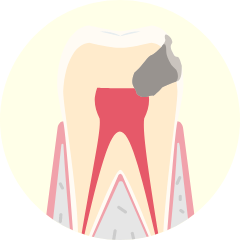 外科治療(重度歯周病の場合)